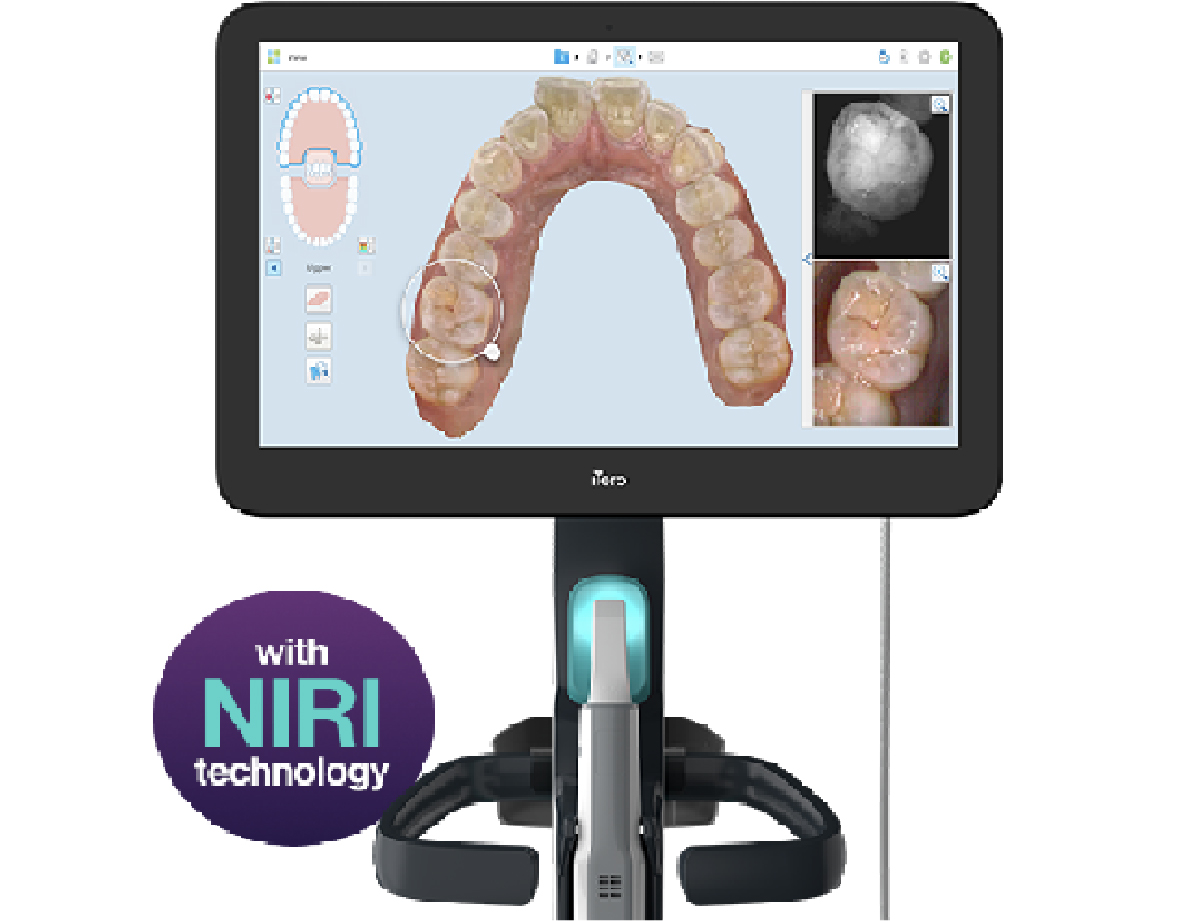 マウスピース矯正インビザラインの3D光学スキャナー「iTero」