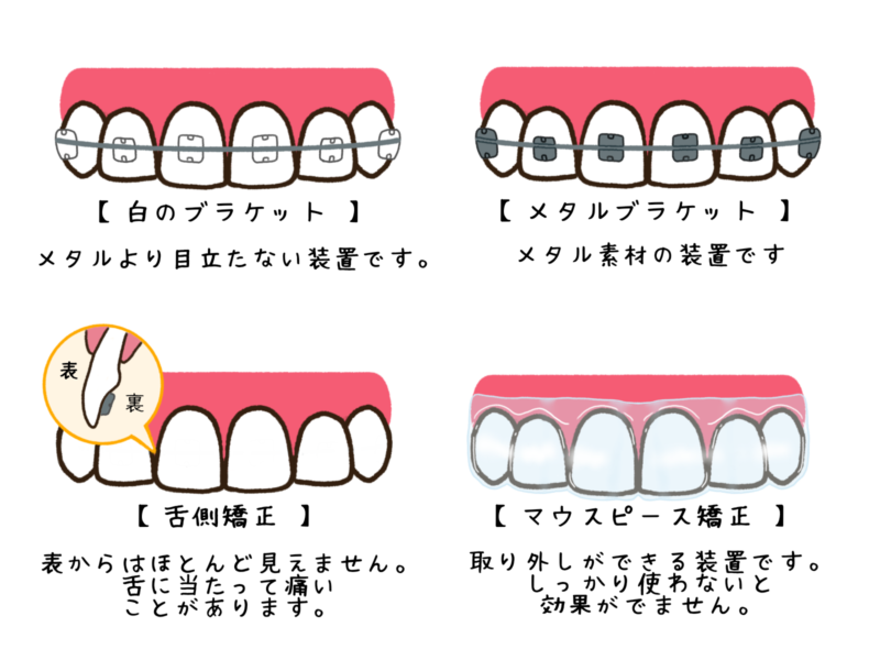 自分に合った歯列矯正の種類を選択する