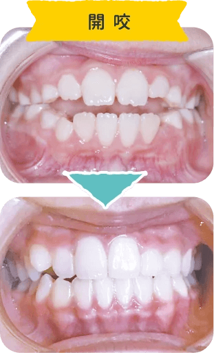③開咬（オープンバイト）｜前歯が噛み合わない