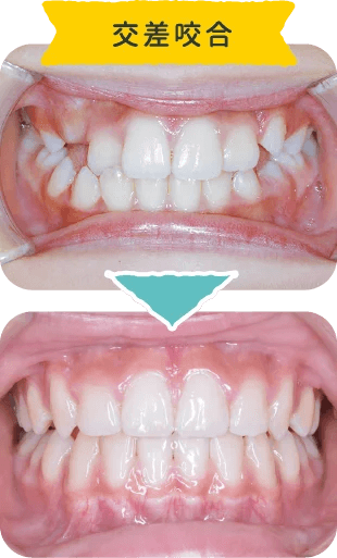 ⑤交叉咬合｜上下の噛み合わせが悪い