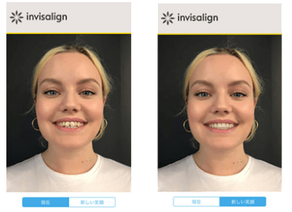 インビザラインスマイルビュー