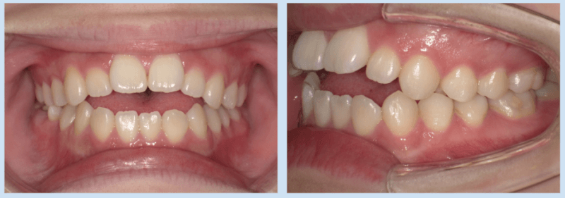 【例2】上下の前歯が噛み合っていないのが気になる方