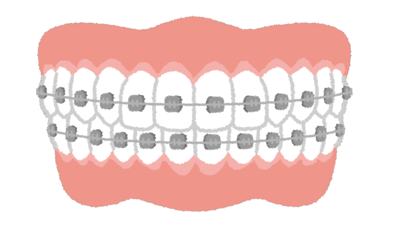 ワイヤー矯正に比べると痛みは少ない特徴がある