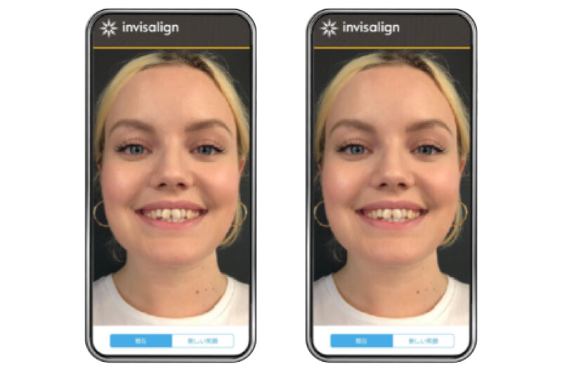 インビザライン スマイルビューで矯正治療後の笑顔のAIシュミレーションもチェック◎​