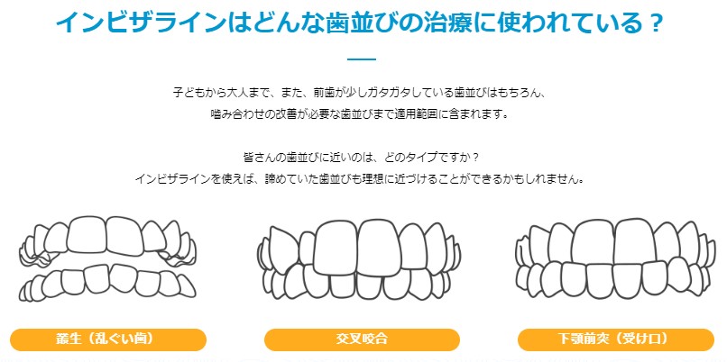 インビザラインで受け口は治る？