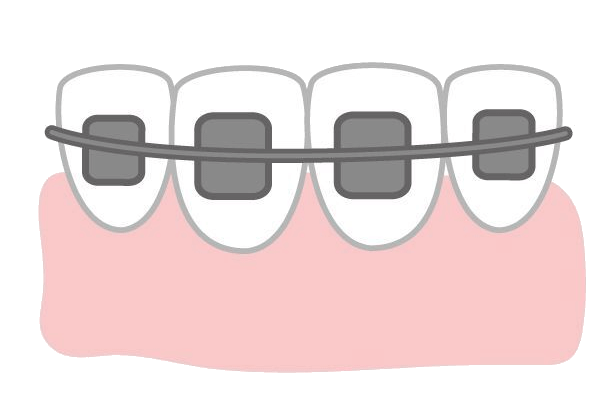 ブラケット矯正とは