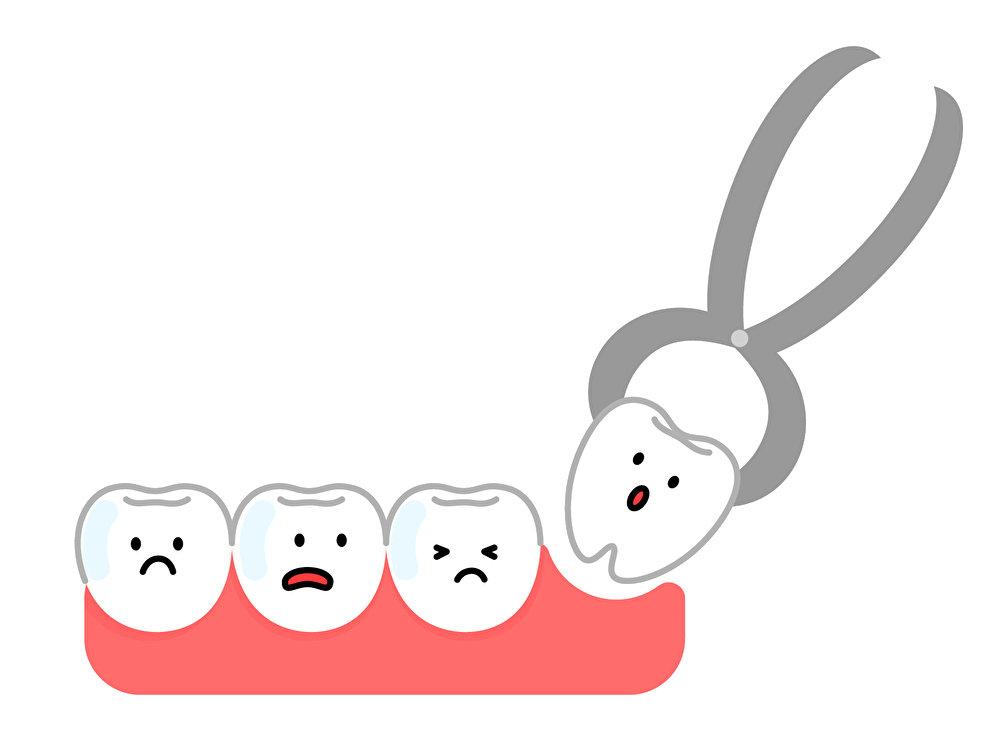 親知らずを矯正治療のために抜歯する必要性は？